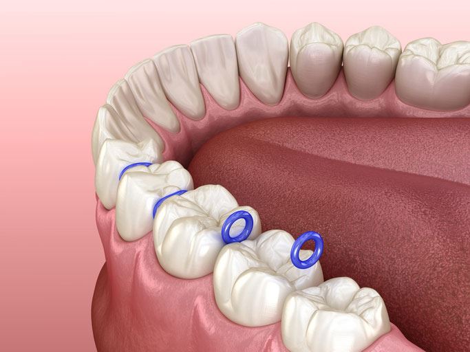 Orthodontic Spacers