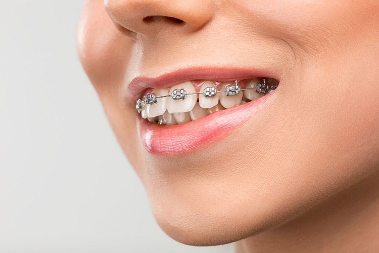 placere Foto homoseksuel Overbite or Buck Teeth: Everything You Need to Know About its Causes,  Risks, & Treatment - Koch Orthodontics