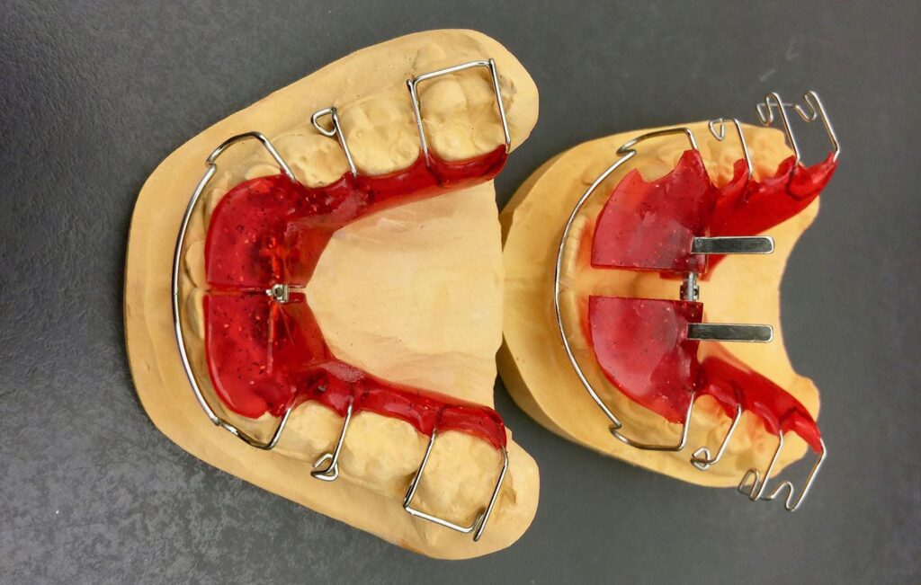 Understanding How Braces Work Koch Orthodontics